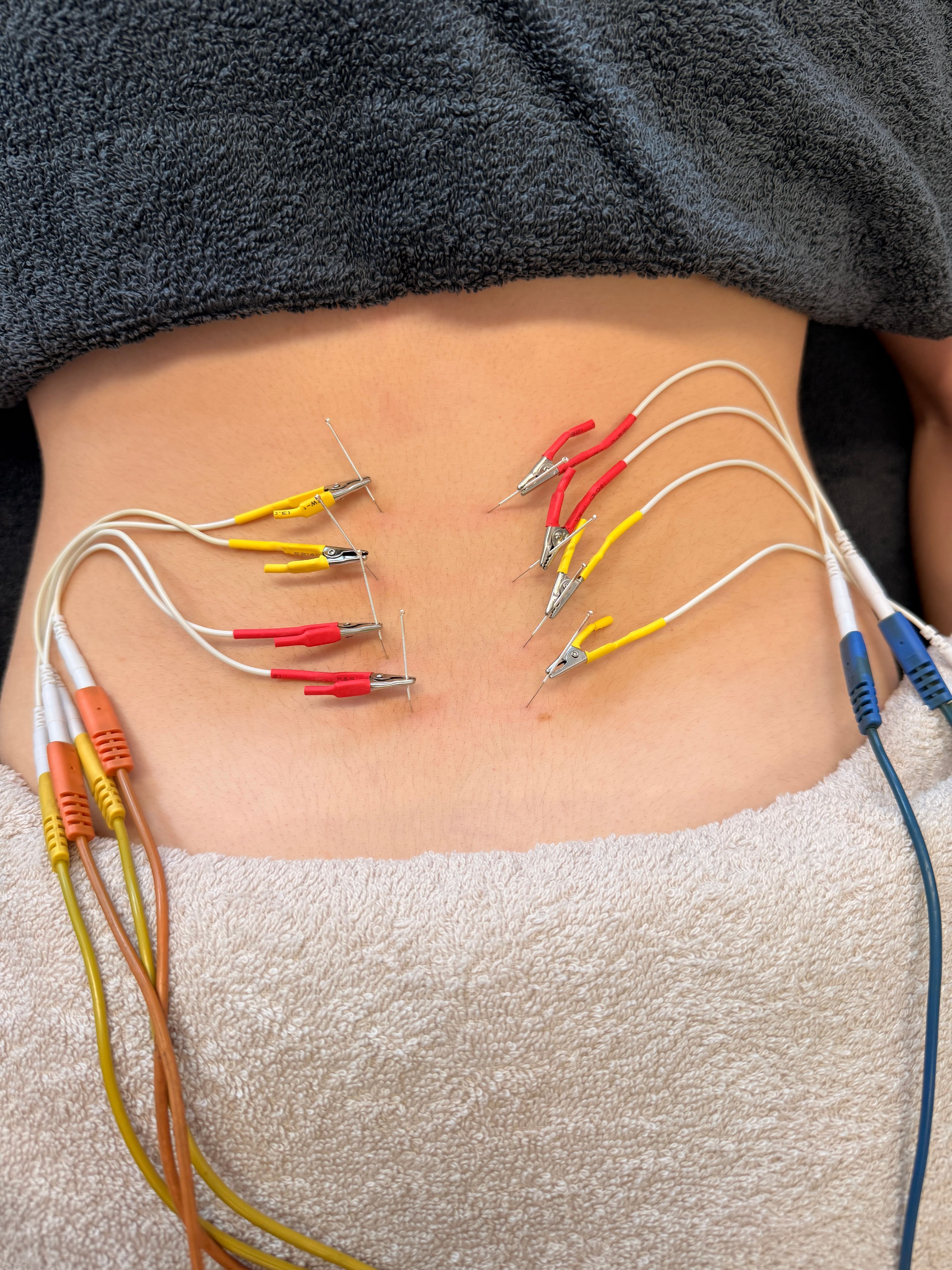 Dry Needling